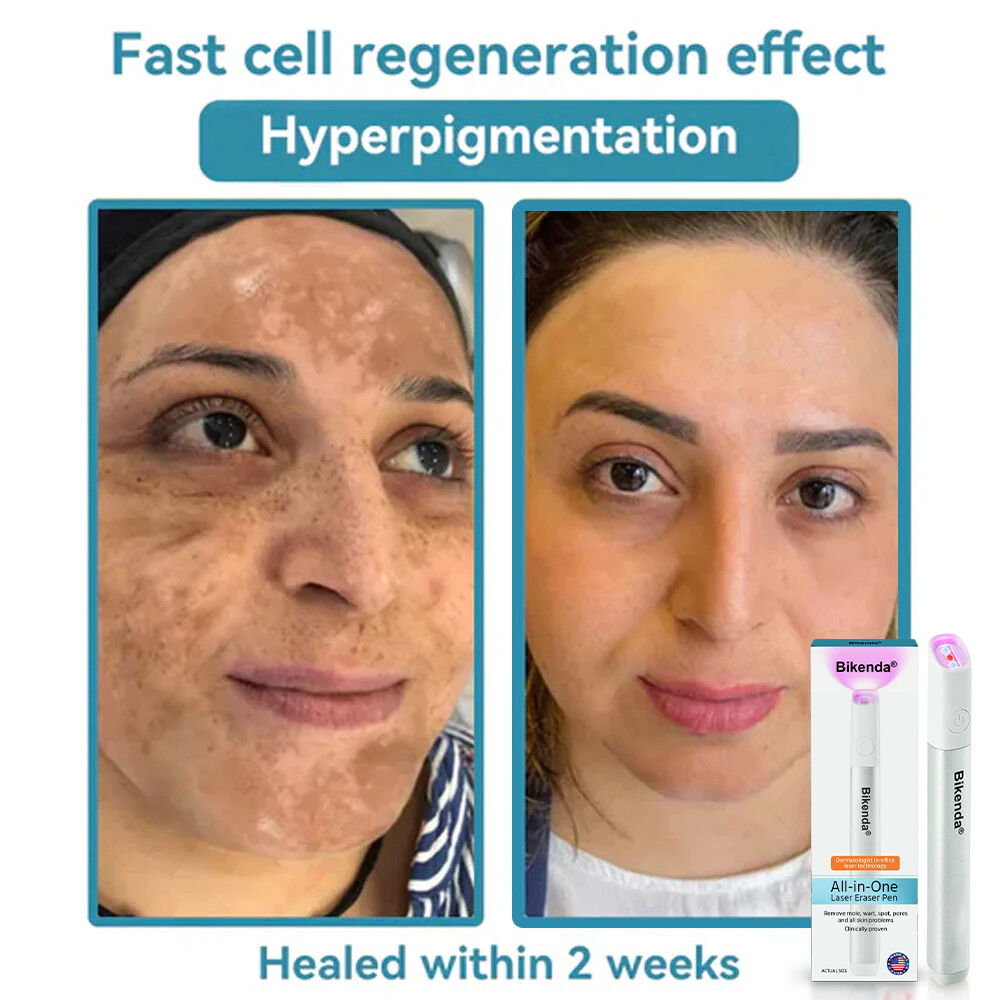 ✨All-in-One CO₂ Laser Eraser Pen | Removes Moles, Warts, Skin Flaws & Pigmentation