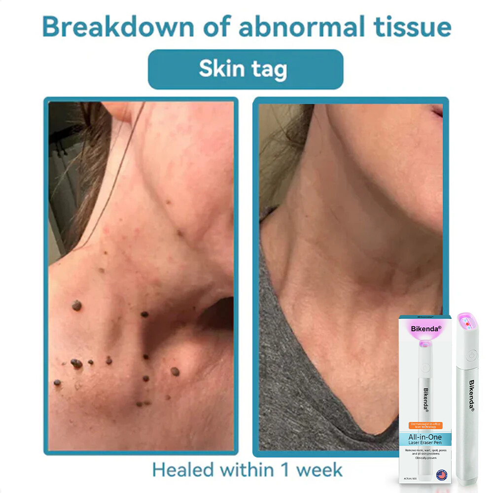 ✨All-in-One CO₂ Laser Eraser Pen | Removes Moles, Warts, Skin Flaws & Pigmentation