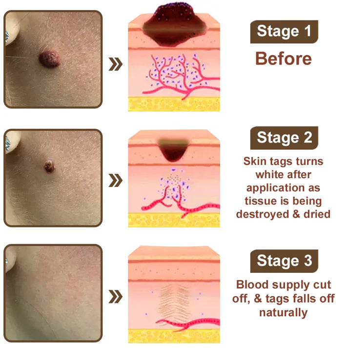 𝑂𝑓𝑓𝑖𝑐𝑖𝑎𝑙 𝑆𝑡𝑜𝑟𝑒 | 𝐷𝑒𝑙ℎ𝑎𝑣𝑒® 17% 𝑆𝑎𝑙𝑖𝑐𝑦𝑙𝑖𝑐 𝐴𝑐𝑖𝑑 𝐵𝑙𝑎𝑐𝑘 𝑅𝑖𝑐𝑒 𝑆𝑘𝑖𝑛 𝑅𝑒𝑝𝑎𝑖𝑟 𝐸𝑠𝑠𝑒𝑛𝑐𝑒 𝐶𝑟𝑒𝑎𝑚 👩‍⚕️ FDA-Certified (For removing warts and skin growths, eliminating skin hyperplasia and keratin buildup, treating skin cancer, age spots, and hyperpigmentation)