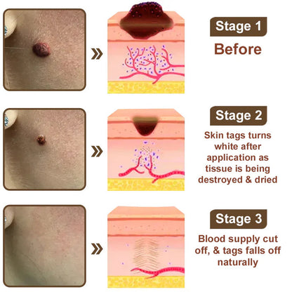 𝑂𝑓𝑓𝑖𝑐𝑖𝑎𝑙 𝑆𝑡𝑜𝑟𝑒 | 𝐷𝑒𝑙ℎ𝑎𝑣𝑒® 17% 𝑆𝑎𝑙𝑖𝑐𝑦𝑙𝑖𝑐 𝐴𝑐𝑖𝑑 𝐵𝑙𝑎𝑐𝑘 𝑅𝑖𝑐𝑒 𝑆𝑘𝑖𝑛 𝑅𝑒𝑝𝑎𝑖𝑟 𝐸𝑠𝑠𝑒𝑛𝑐𝑒 𝐶𝑟𝑒𝑎𝑚 👩‍⚕️ FDA-Certified (For removing warts and skin growths, eliminating skin hyperplasia and keratin buildup, treating skin cancer, age spots, and hyperpigmentation)