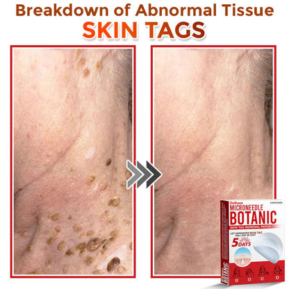 DELHAVE® MicroNeedle Botanic Skin Tag Removal Patch 🇺🇸 Made in the USA